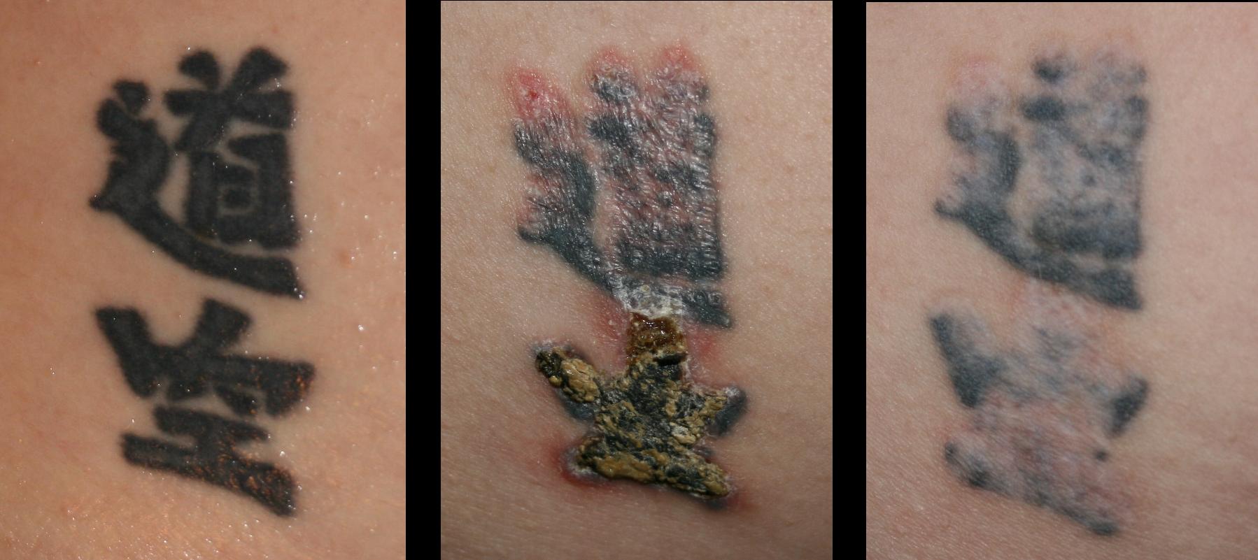 tattoo removal industry by combining laser and non laser technologies